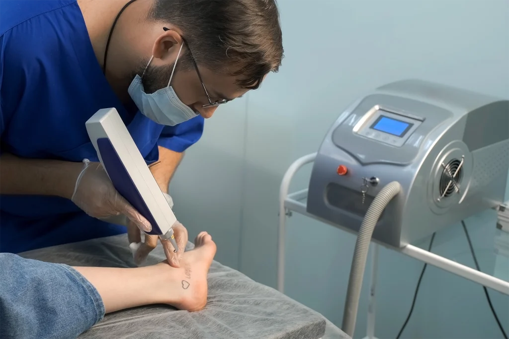 Professional working on removing tattoo from a foot.